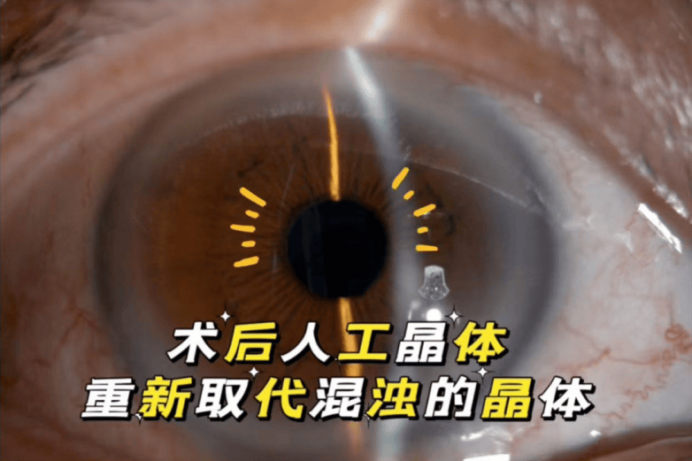 53岁男子摆脱700度高度近视+白内障，佛山爱尔眼科三焦点晶体助其重返清晰视界