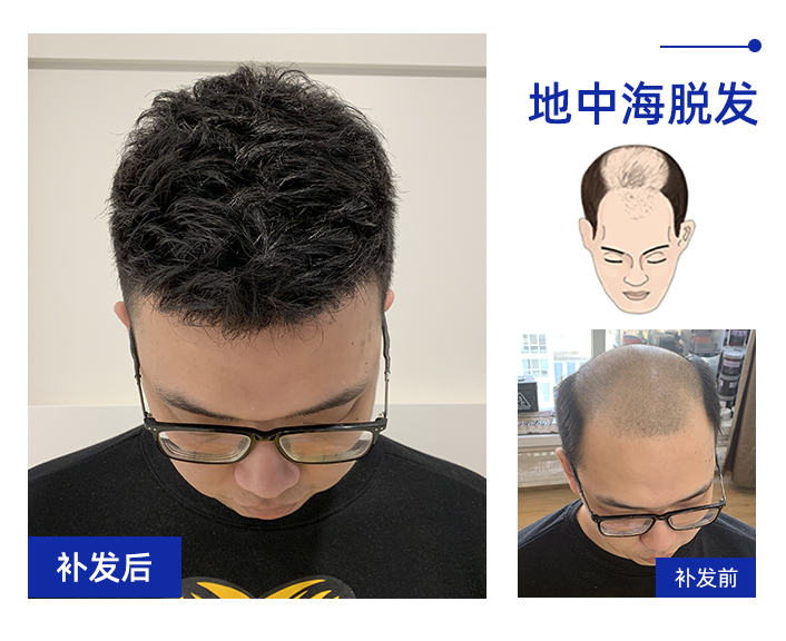 地中海式补发