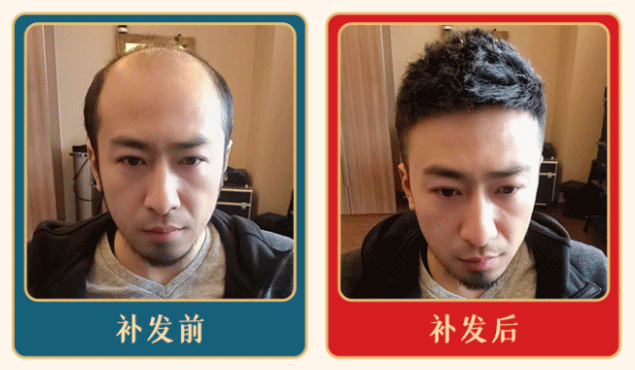 发际线补发
